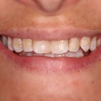 Composite Veneers - Smile 1 before